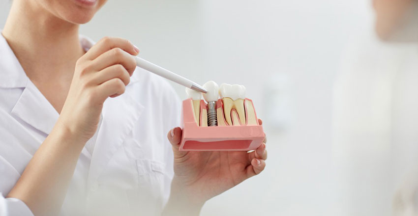 Dentist Holding a Dental Implant Example dummy